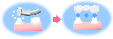 土台の歯を削る必要のあるブリッジ