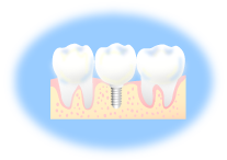 インプラントなら土台の歯が不要