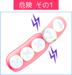 入れ歯の危険性１